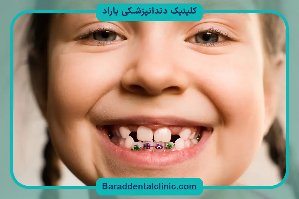 سیم کشی دندان در چه سنی مناسب است؟ سیم کشی در بزرگسالی