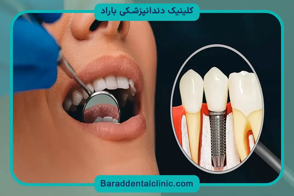 بازسازی قوس دندان با ایمپلنت جدید دندان 