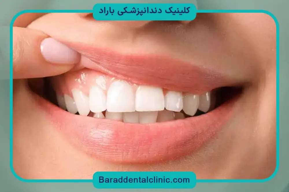 مراحل جراحی لثه برای ایمپلنت