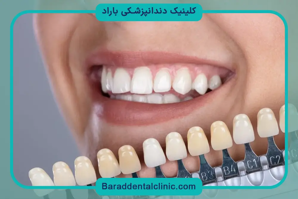 پوشش قیمت کامپوزیت با بیمه