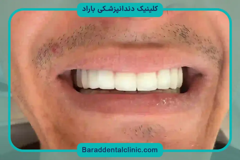 شرایط پرداخت قیمت کامپوزیت کل دندان ها 