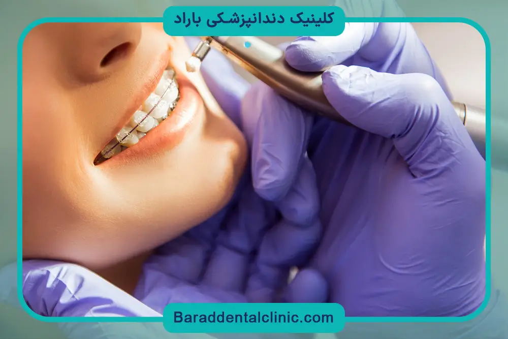 پرداخت اقساطی قیمت حدودی سیم کشی دندان 