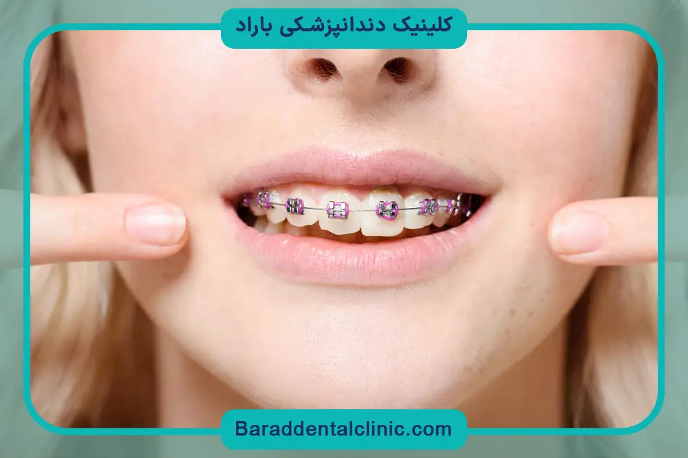 طول درمان سیم کشی دندان خرگوشی 