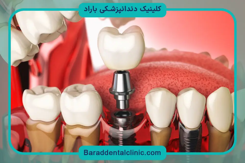 شرایط استفاده از خدمات بهترین مرکز ایمپلنت تهران 
