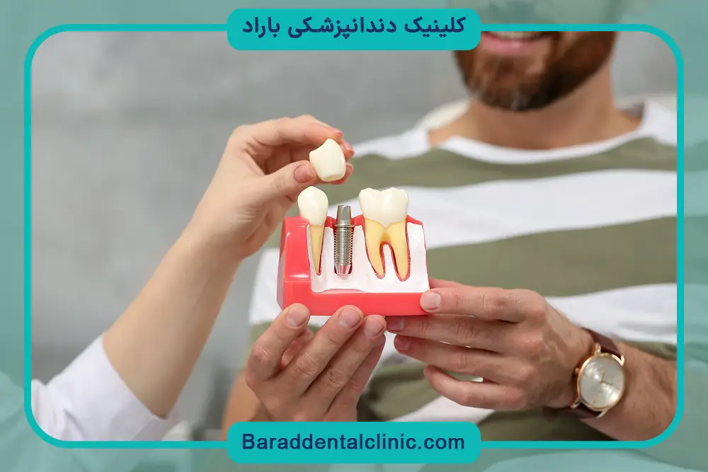 تاثیر نوع روکش روی قیمت ایمپلنت دندان در تهران 