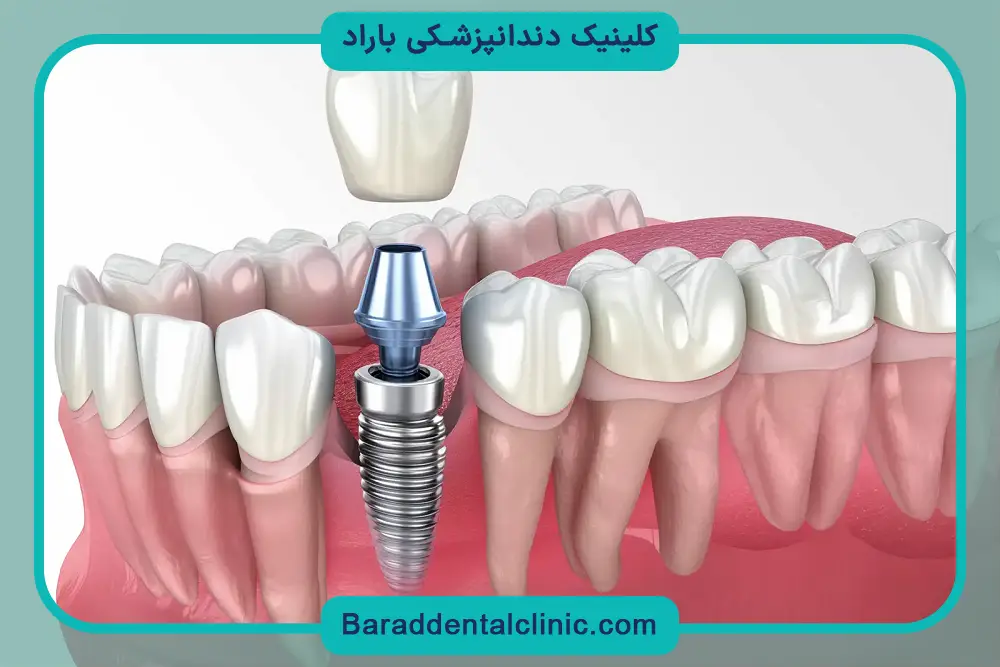 تاثیر روکش روی قیمت ایمپلنت یک دندان