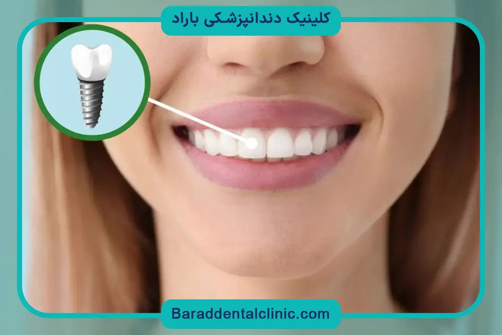 هزینه ایمپلنت ثابت فک بالا 