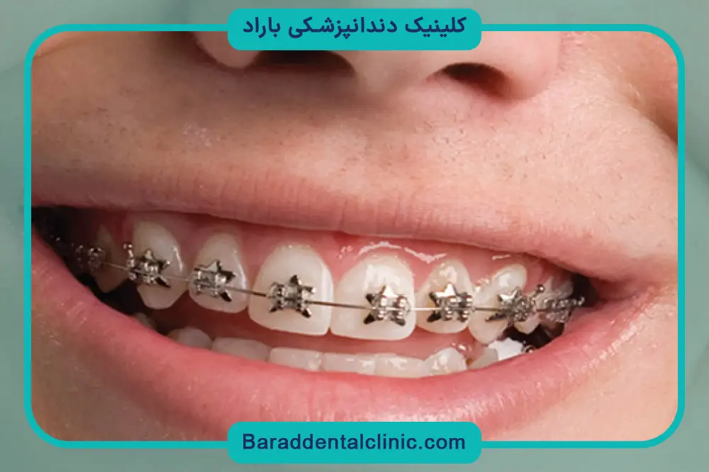 سیم کشی دندان چگونه انجام میشود؟ نکات تغذیه‌ای
