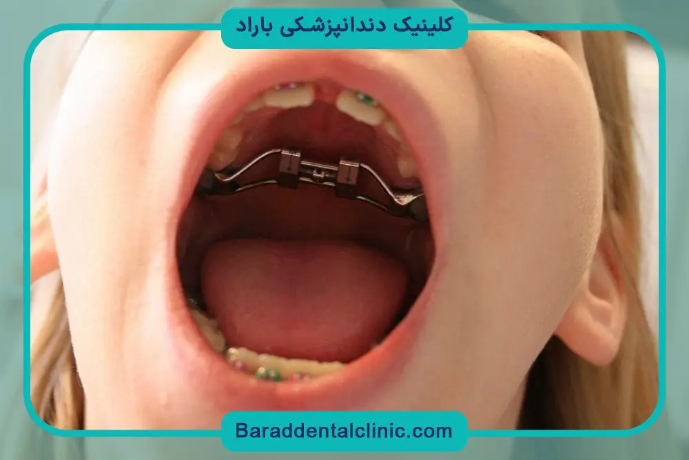 سیم کشی دندان در چه سنی مناسب است؟ دوره نقاهت در کودکی و بزرگسالی