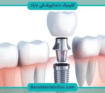 عوارض ایمپلنت دندان