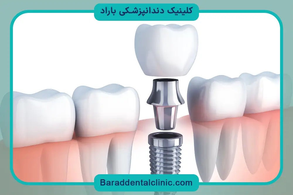 عوارض ایمپلنت دندان