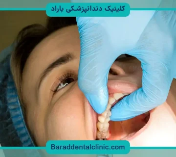 جراحی دندان عقل