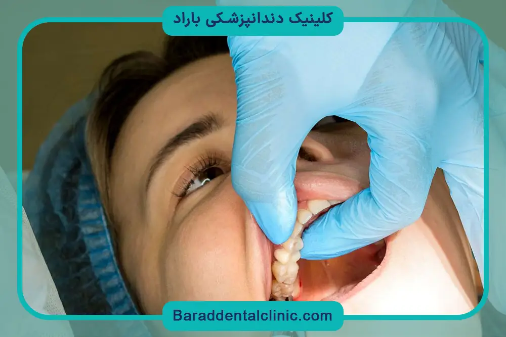جراحی دندان عقل