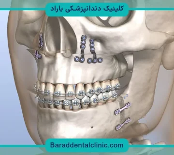 عمل جراحی فک بالا