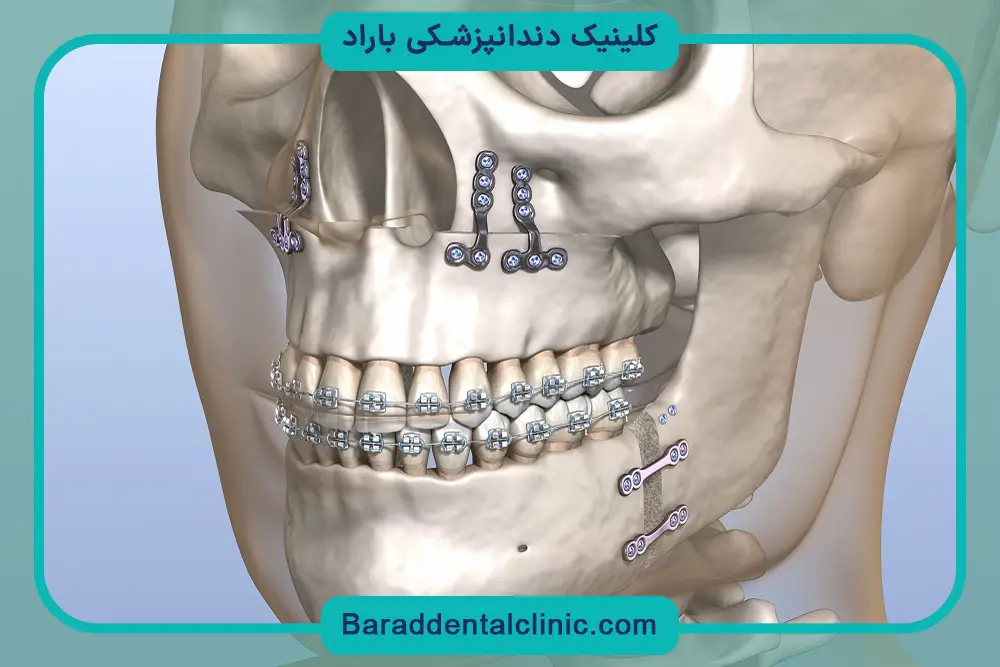 عمل جراحی فک بالا