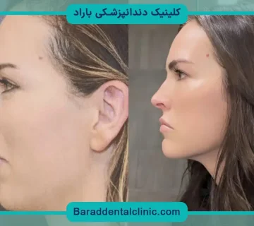 عمل جراحی فک پایین