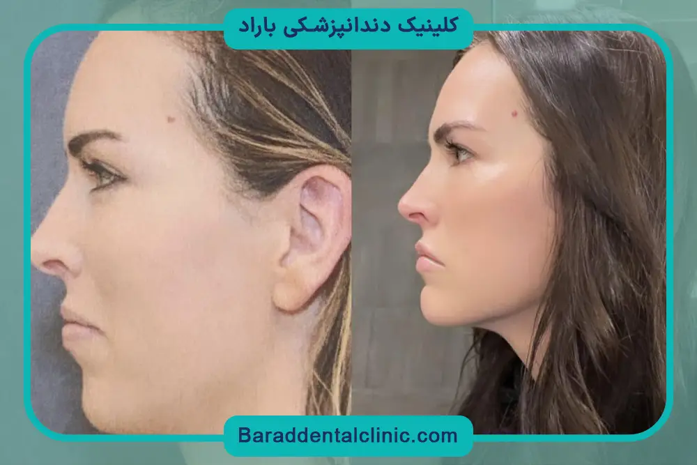 عمل جراحی فک پایین