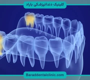 دندان عقل چیست؟
