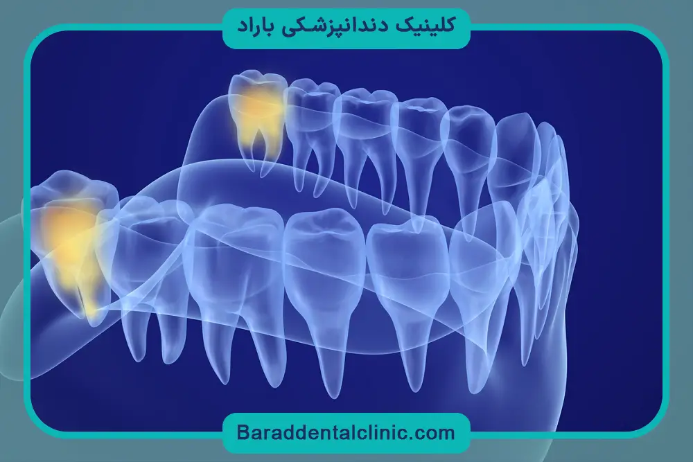 دندان عقل چیست؟