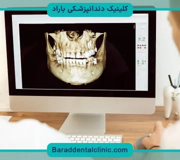 قیمت ایمپلنت دیجیتال در تهران