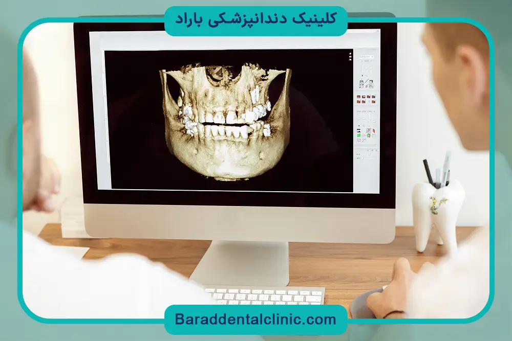 قیمت ایمپلنت دیجیتال در تهران