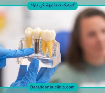 ایمپلنت اقساطی بدون چک