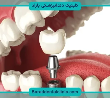 ایمپلنت دندان چقدر طول میکشد
