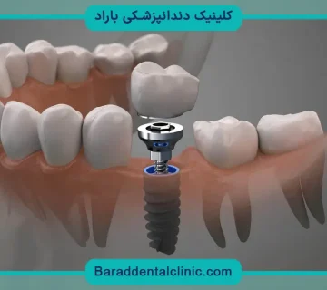 ایمپلنت اقساطی با سفته
