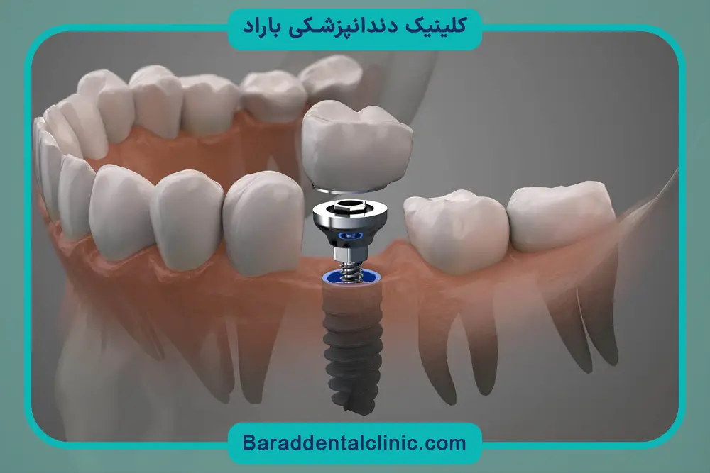 ایمپلنت اقساطی با سفته