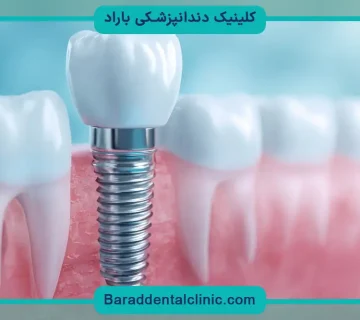 مراحل ایمپلنت فوری