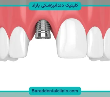 مزایا و معایب ایمپلنت فوری