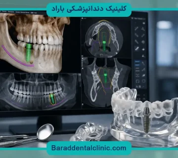 هزینه ایمپلنت دیجیتال در تهران