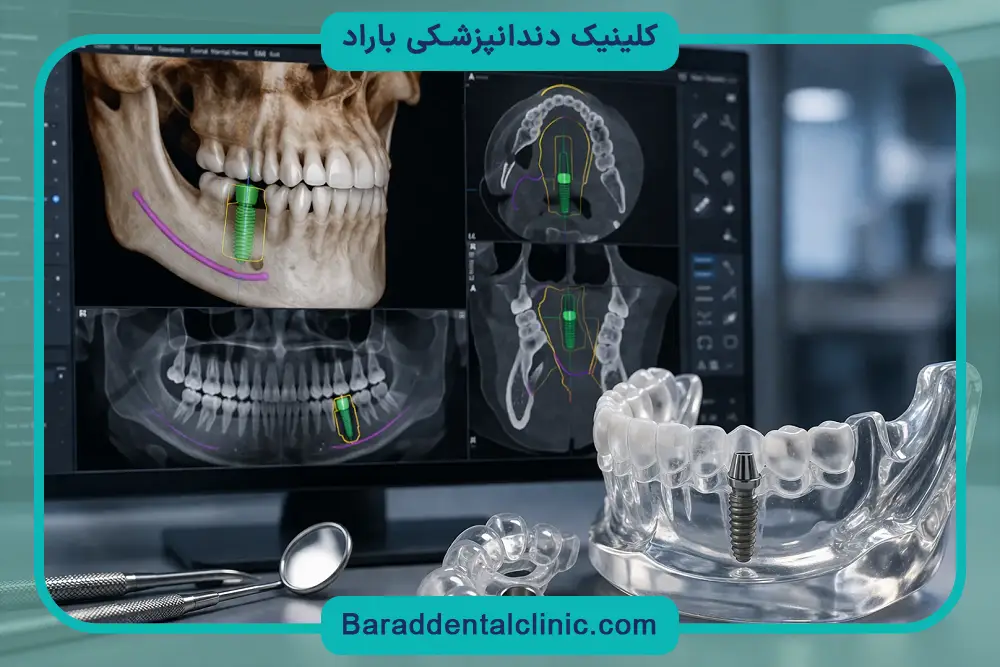 هزینه ایمپلنت دیجیتال در تهران
