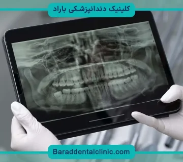 ایمپلنت دیجیتال بهتره یا معمولی