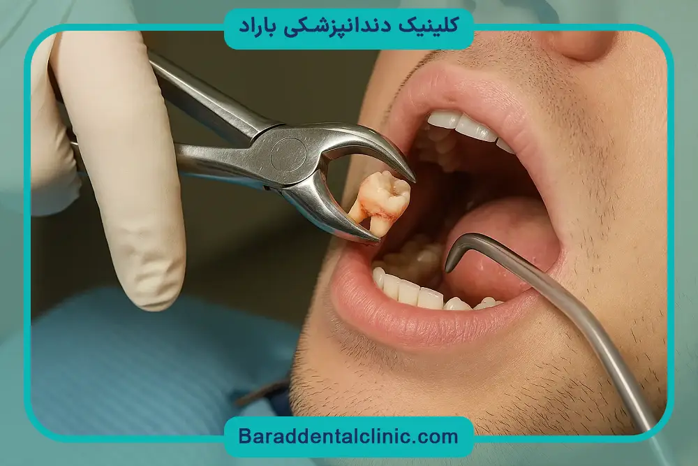 دلایل نیاز به جراحی دندان عقل 