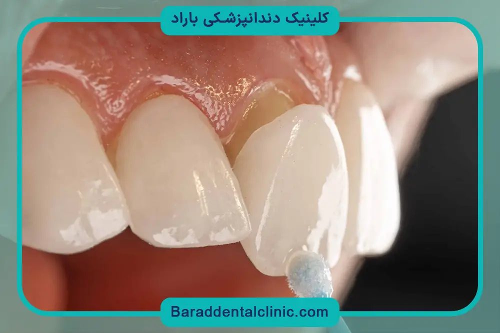 ویژگی‌های بهترین کلینیک کامپوزیت تهران 