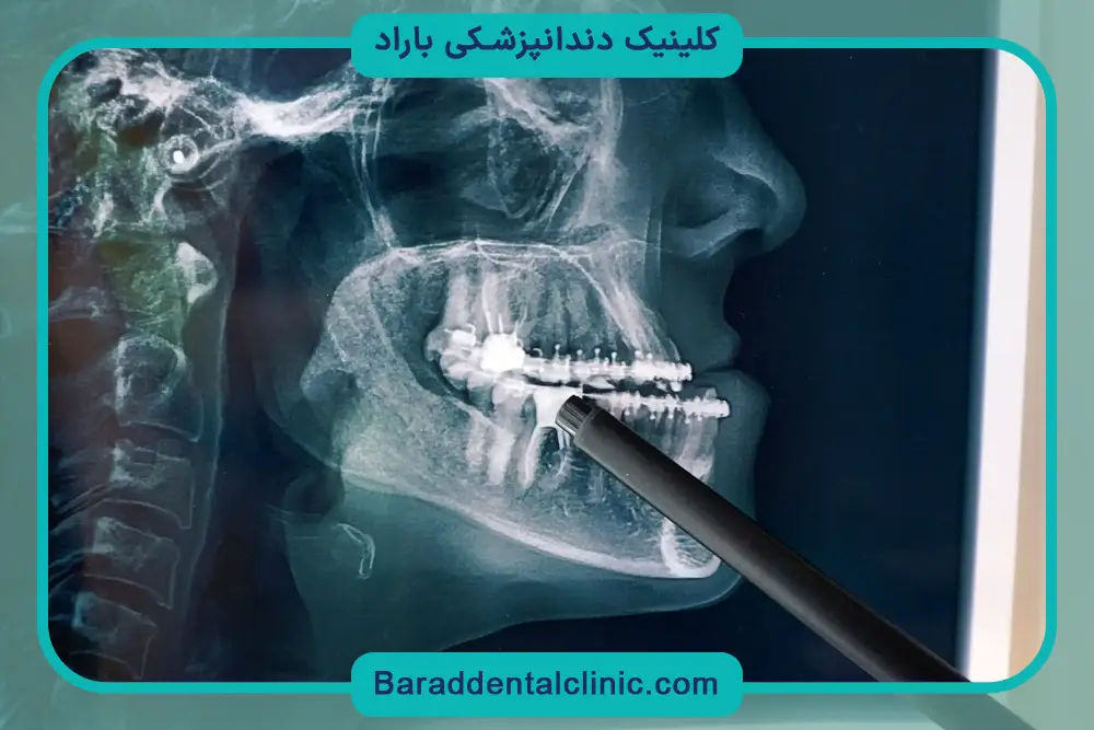 کاندیدای جراحی ارتوگناتیک 