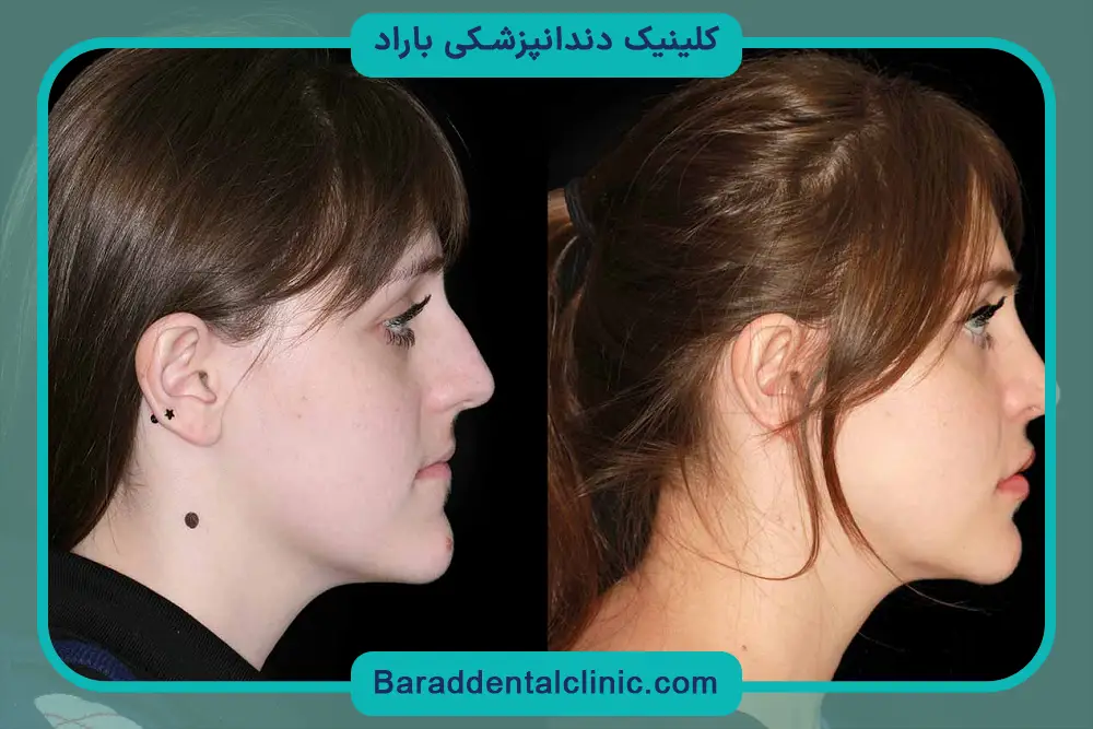 زمان نیاز به عمل جراحی فک بالا 