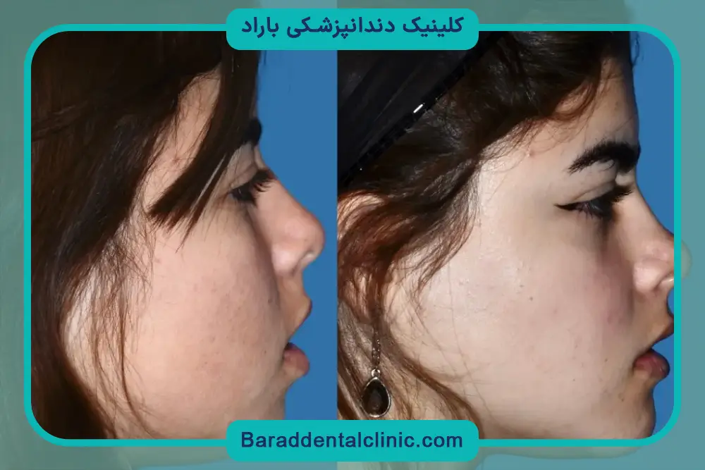کاندیدای عمل جراحی فک پایین 
