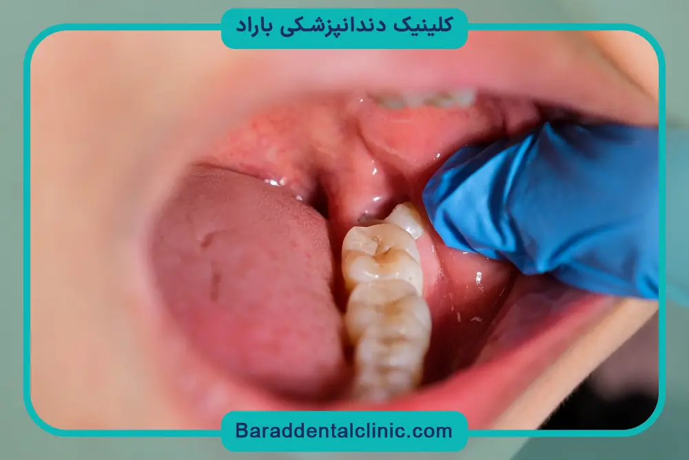 جراحی دندان عقل روییده چیست؟