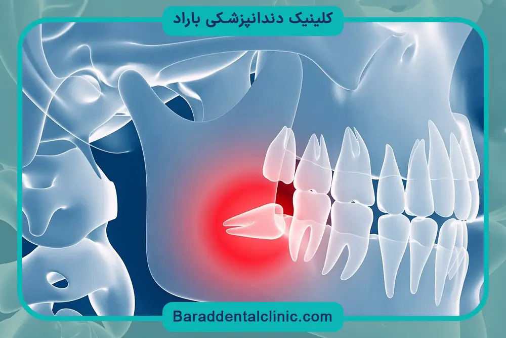 عوامل موثر بر رویش دندان عقل چیست؟ 