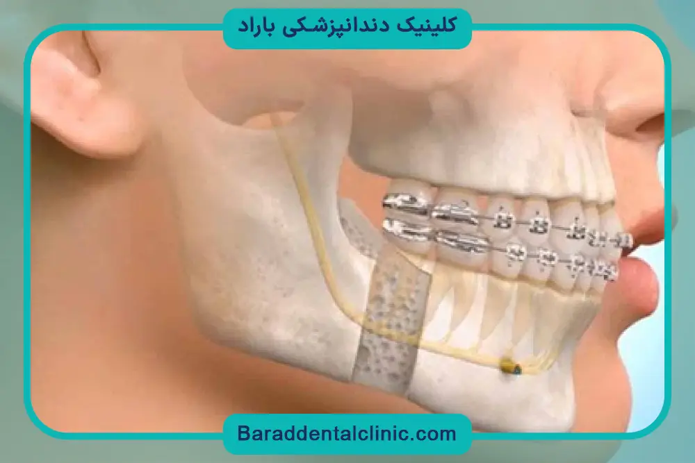 زمان جراحی فک و صورت 