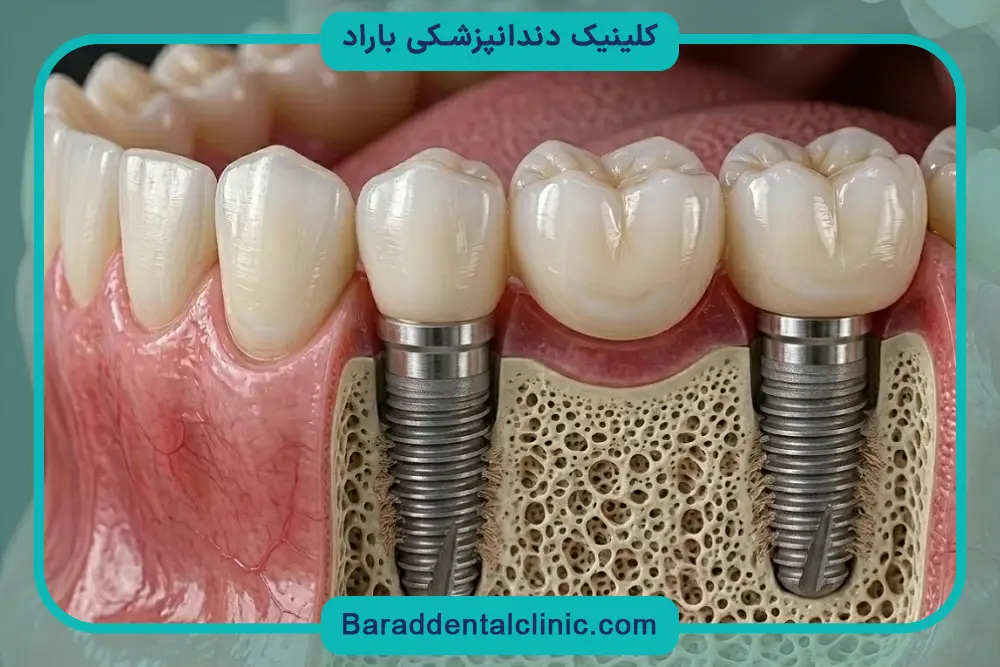 خونریزی از عوارض ایمپلنت دندان