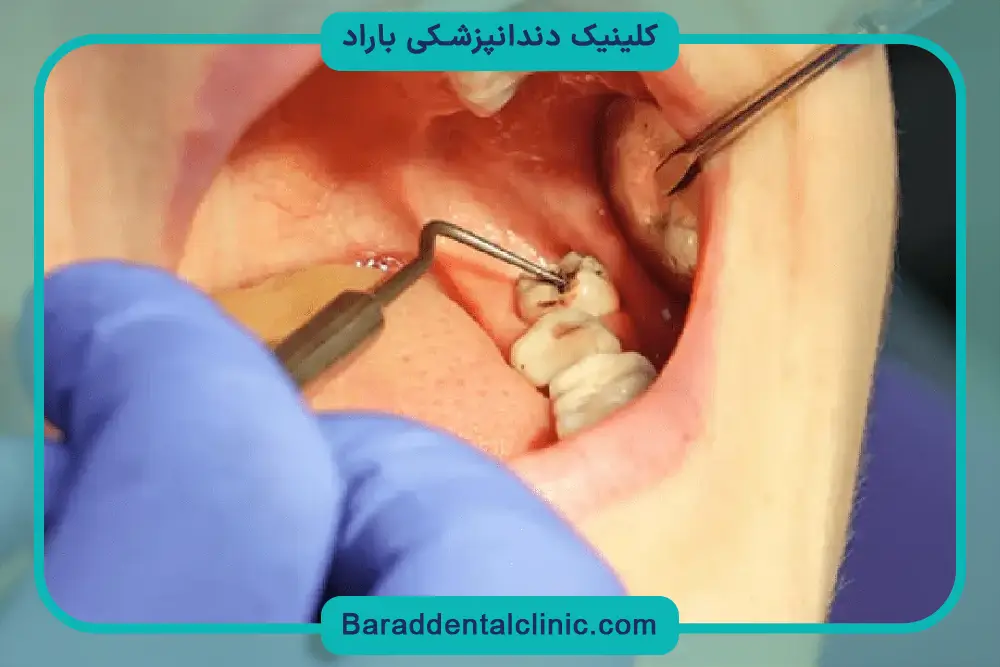 آمادگی قبل از جراحی دندان عقل 