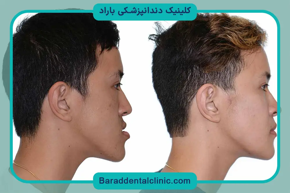 انواع روش‌های عمل جراحی فک پایین 
