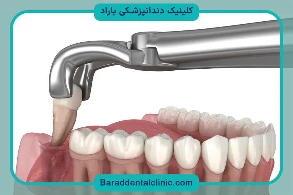 علائم نیاز به جراحی دندان عقل روییده 