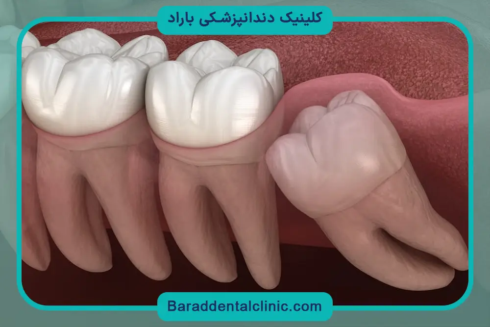 علائم رویش دندان عقل چیست؟ 