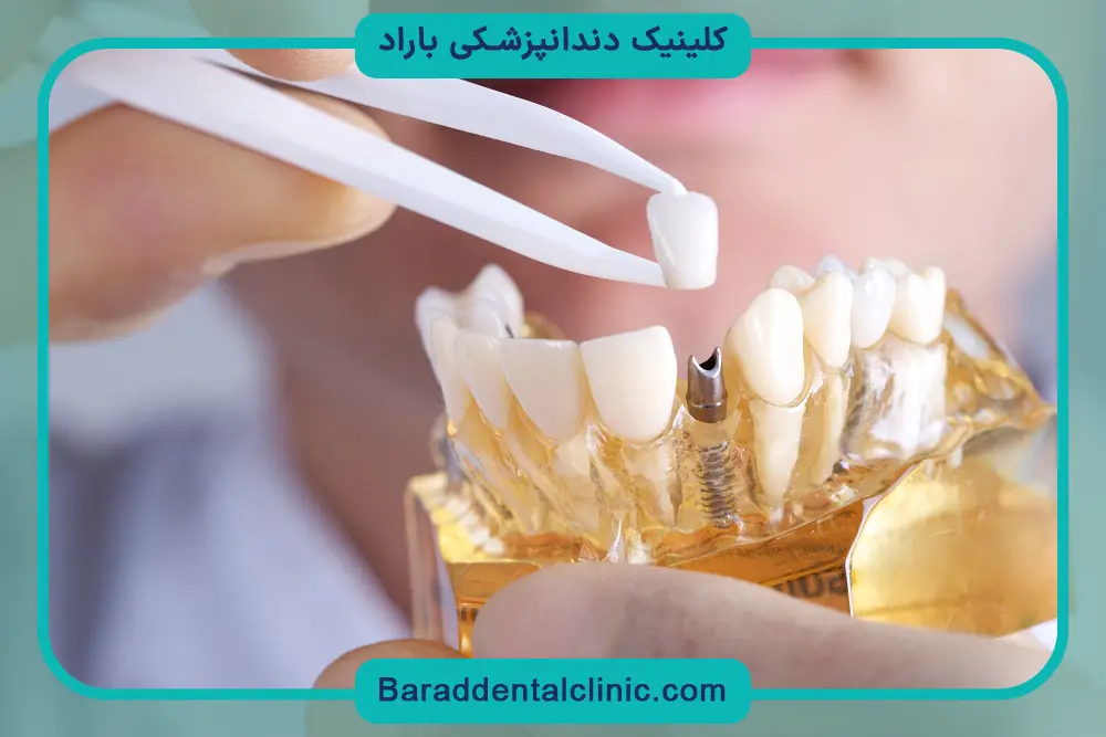 بررسی هزینه ایمپلنت اقساطی بدون چک 