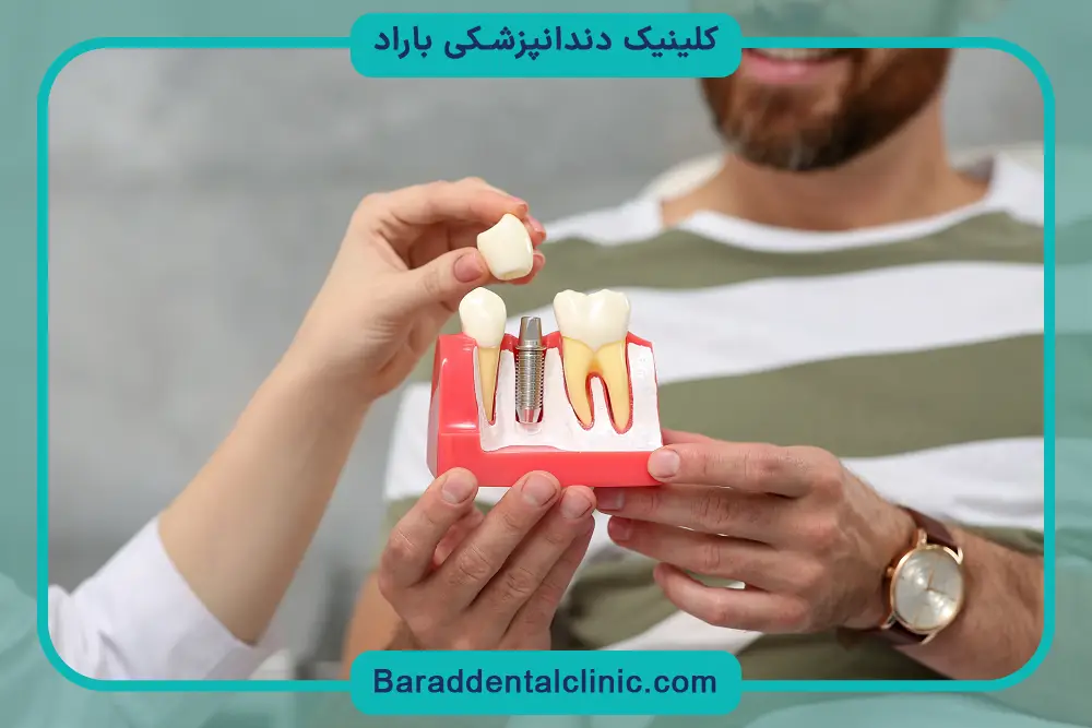 ایمپلنت دندان چقدر طول میکشد؟ دوره جوش خوردن