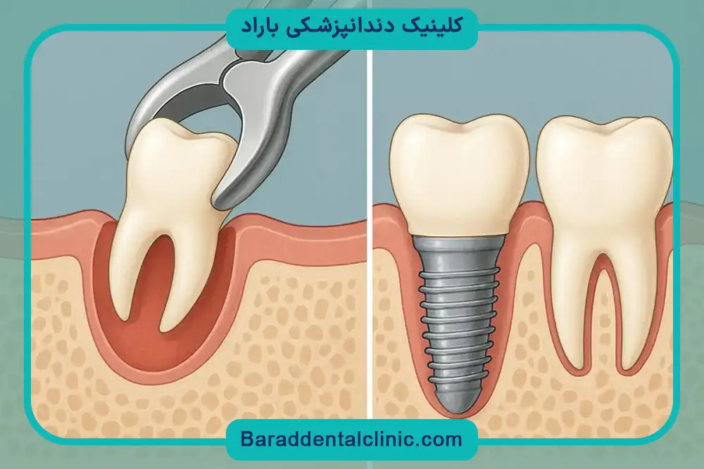 پس زدن ایمپلنت از عوارض ایمپلنت دندان